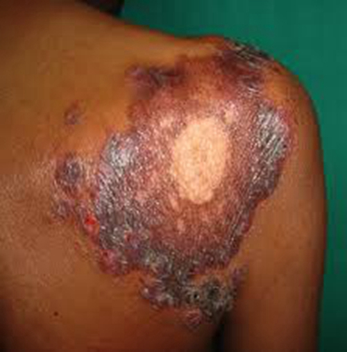 三期梅毒皮肤图片