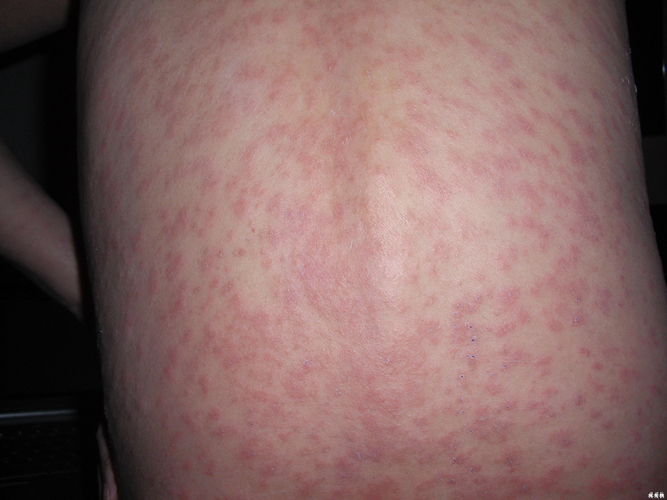 热毒湿疹症状图片湿气图片