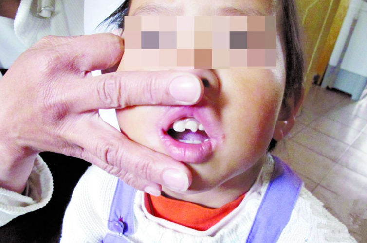 儿童早期虫吃牙图片图片