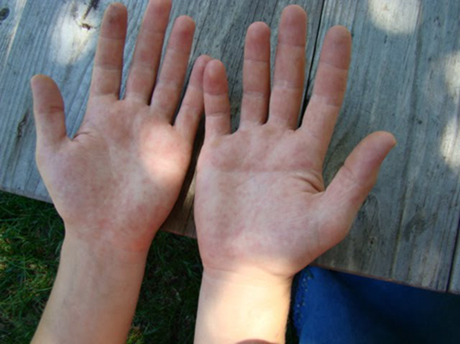 手足口病初期症状双手是什么样图片