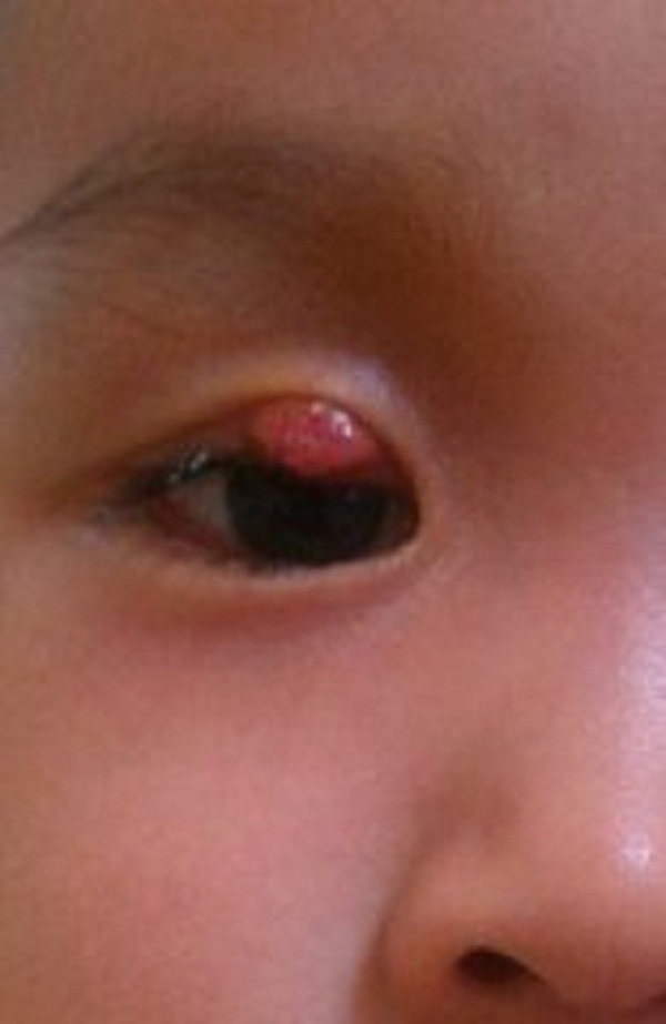 儿童眼眶囊肿图片图片