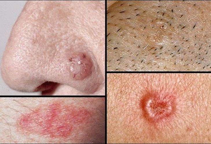 女性皮肤癌一般在哪里图片