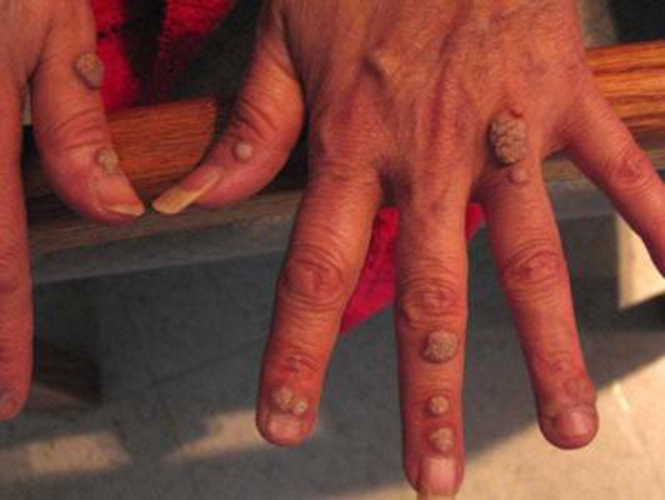 手指瘊状扁平疣图片