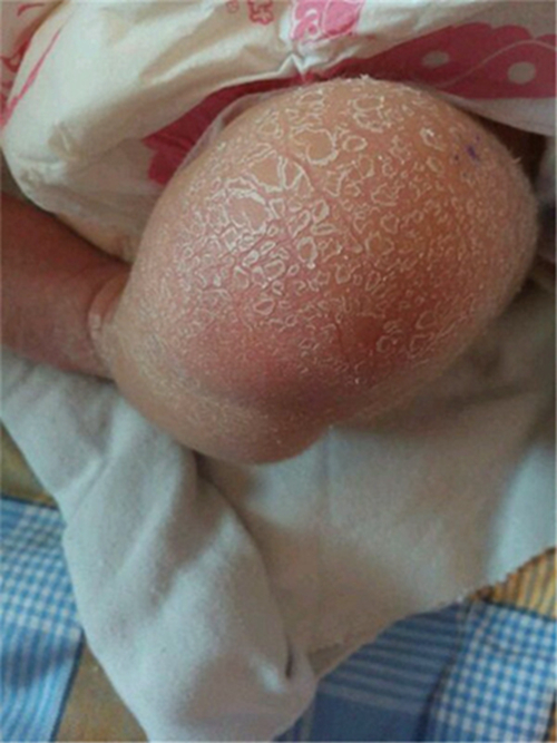 婴儿皮肤干燥像鱼鳞图片