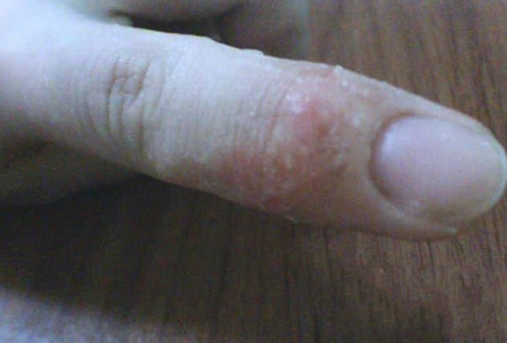 手部湿疹在手指上的图片