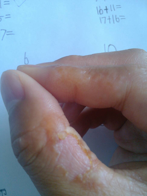 手部湿疹的症状图片