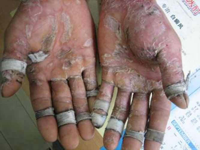 手部湿疹治疗的图片