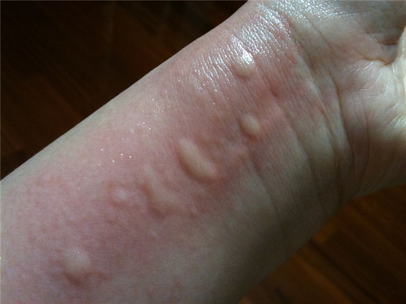 冷空气过敏荨麻疹图片图片