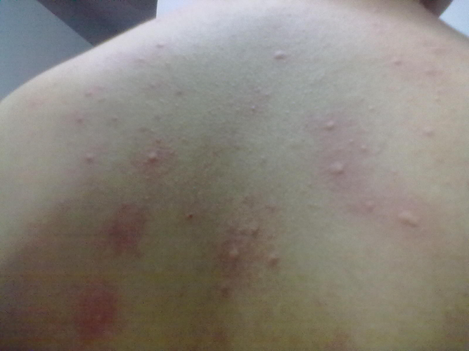 成人背部湿疹痱子图片