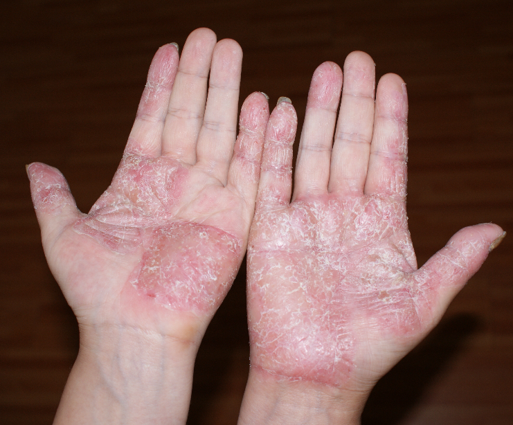 手足湿疹症状图片图片