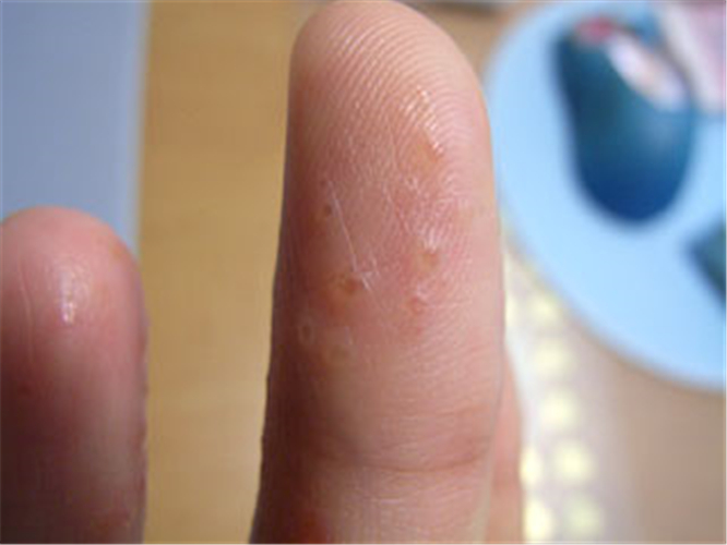 湿疹型手气的症状图片图片