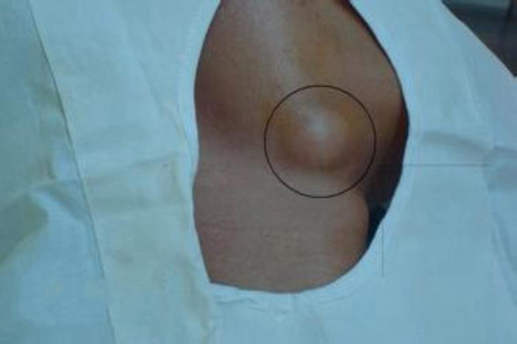 皮脂腺囊肿后期图片图片