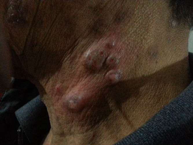 男生的阴囊粉瘤图片