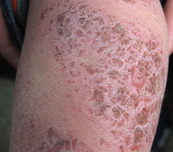 真菌性皮肤病初期图片