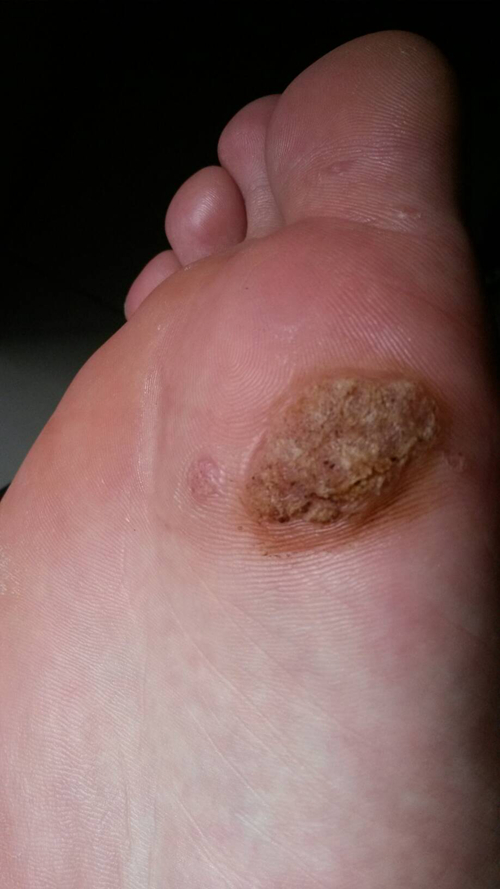 真菌性皮肤病脚部图片