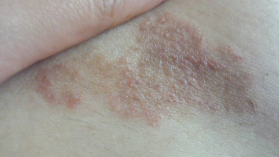 皮肤真菌感染 初期图片