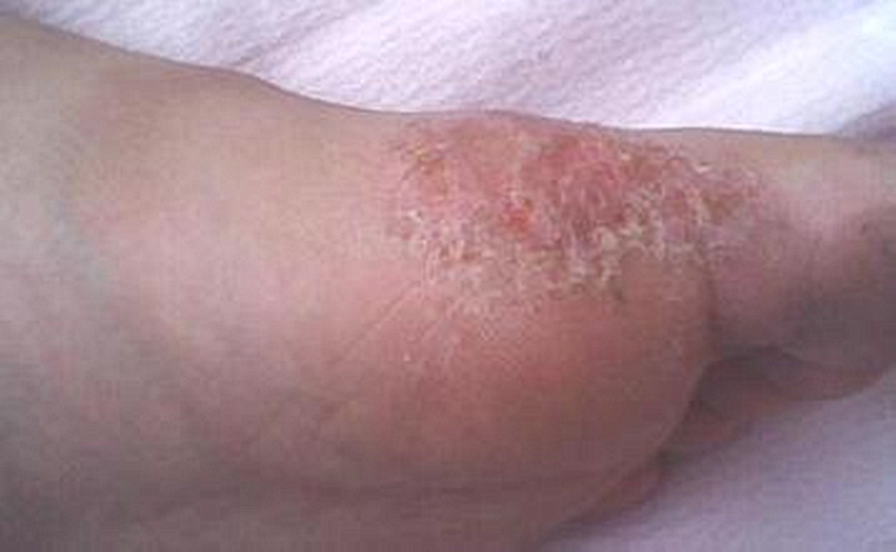 真菌性皮肤病脚