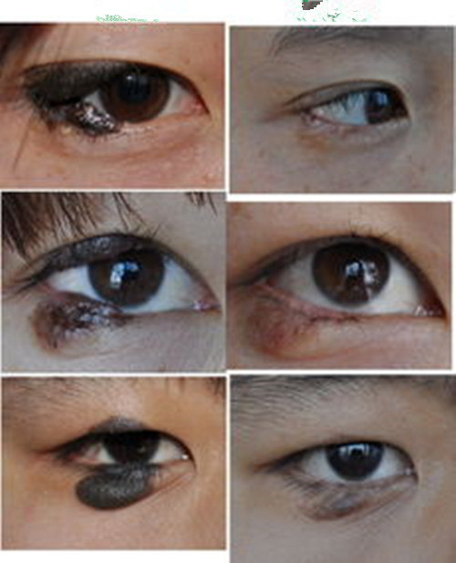 眼睑色素痣治疗过程