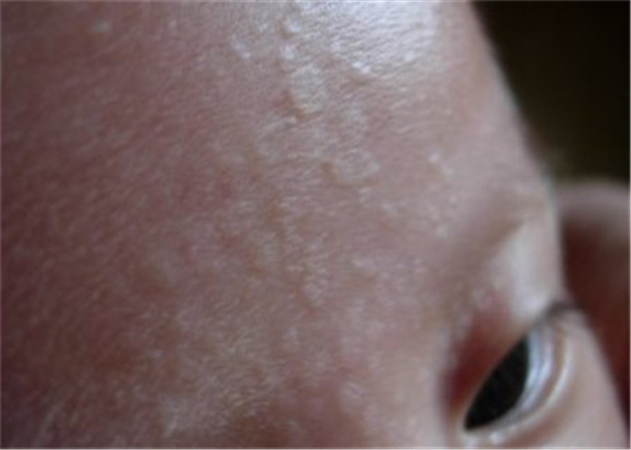 花斑癣孩子额头皮肤炎症图片