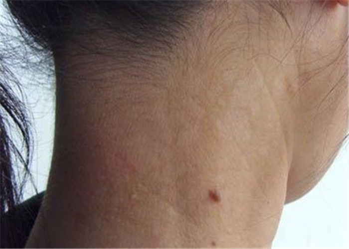 花斑癣女性脖子部位症状图片