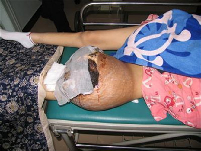 软骨肉瘤患者晚期图片图片