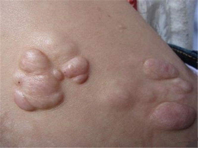 多发性皮肤外脂肪瘤图片 