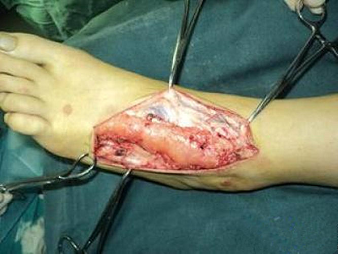 脚背恶性脂肪瘤图片