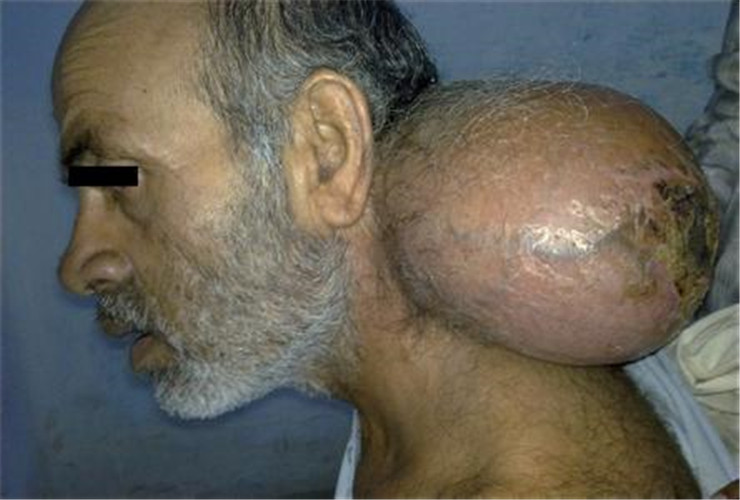 老年男人颈部皮下脂肪瘤图片