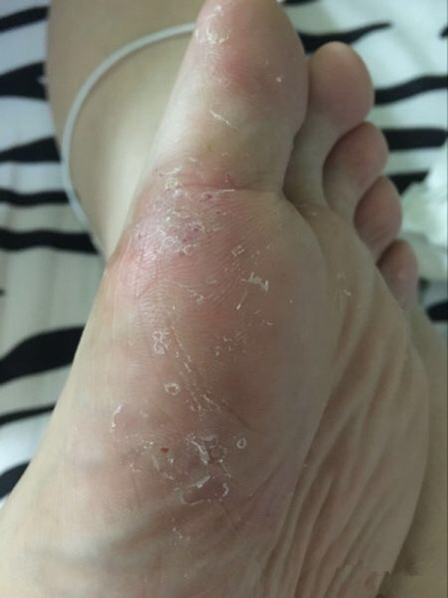 真菌脚气感染的图片