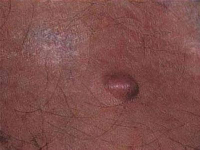 男士脂肪瘤初期图片