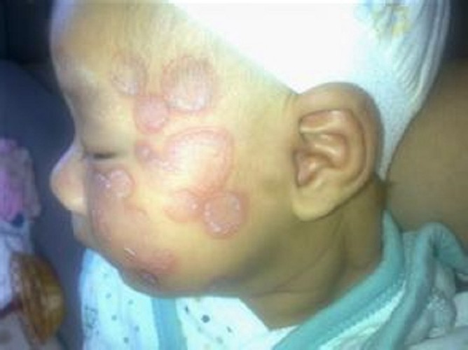 儿童红斑狼疮早期症状图片