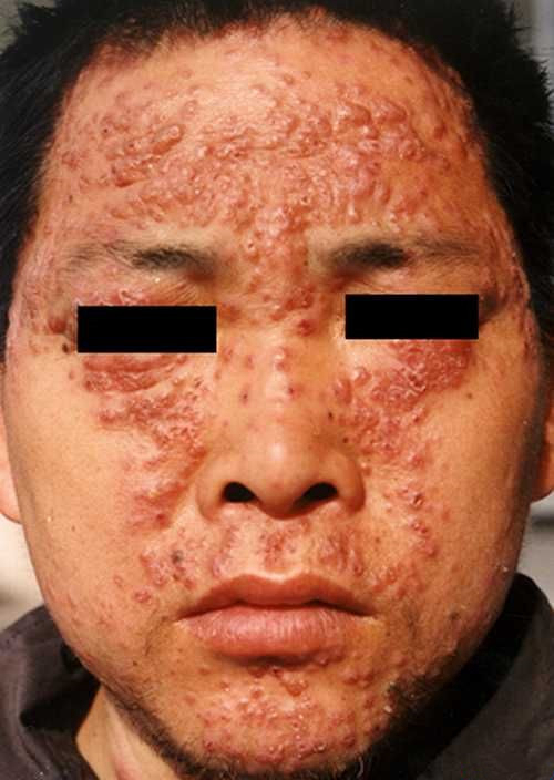 中年男子脸部红斑狼疮症状图片