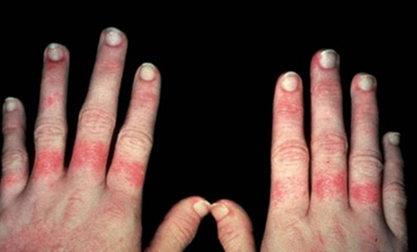 双手症状红斑狼疮晚期图片