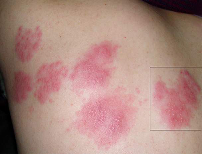 艾滋病皮肤大红点症状图片