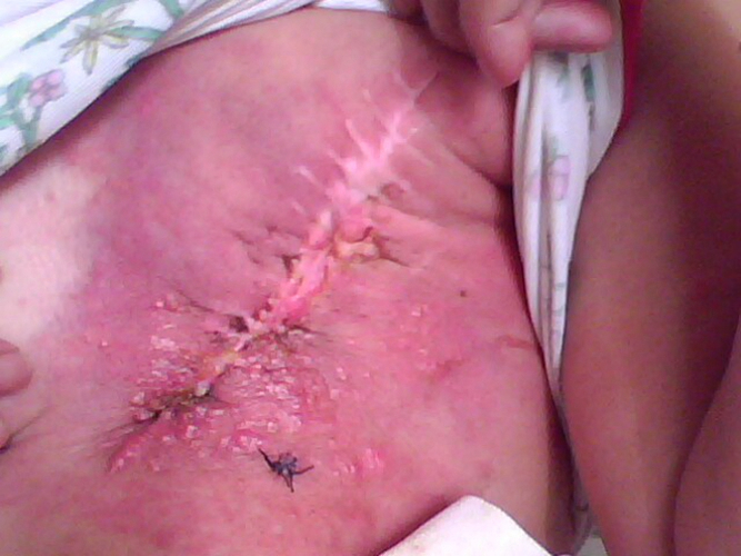 乳腺癌初期手术后图片