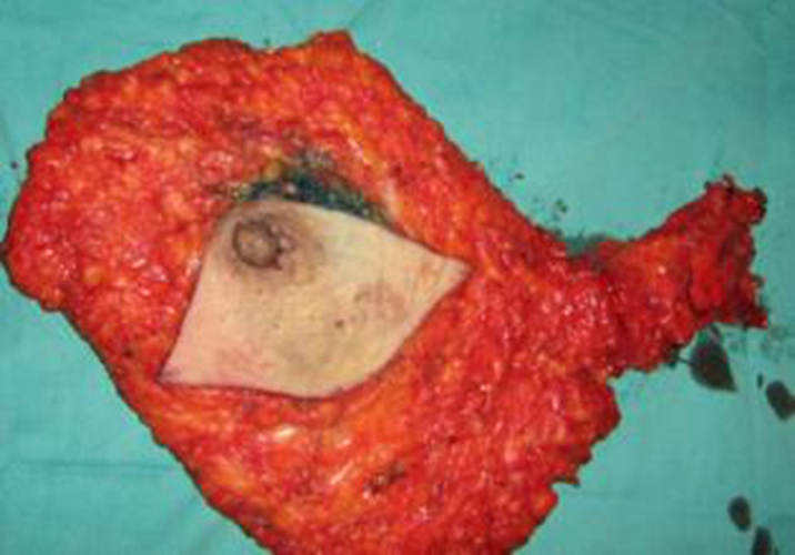 乳房切除后癌细胞乳腺癌图片
