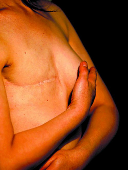 乳腺癌患者右乳房图片