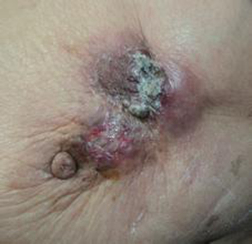 乳腺癌晚期可以用药的图片