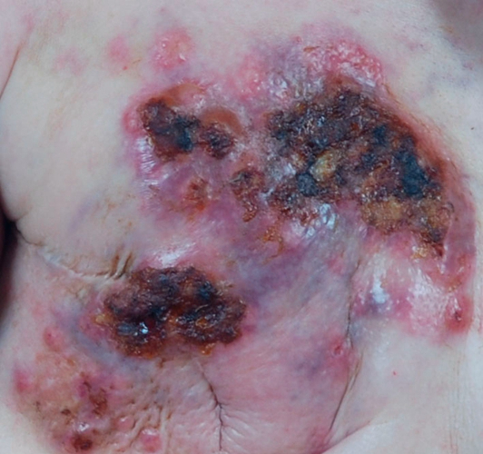 乳腺癌淋巴结活检手术后伤口附近出现皮肤病图片
