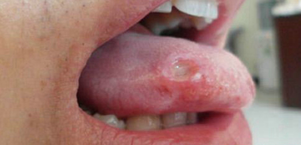 一期梅毒图片舌头图片