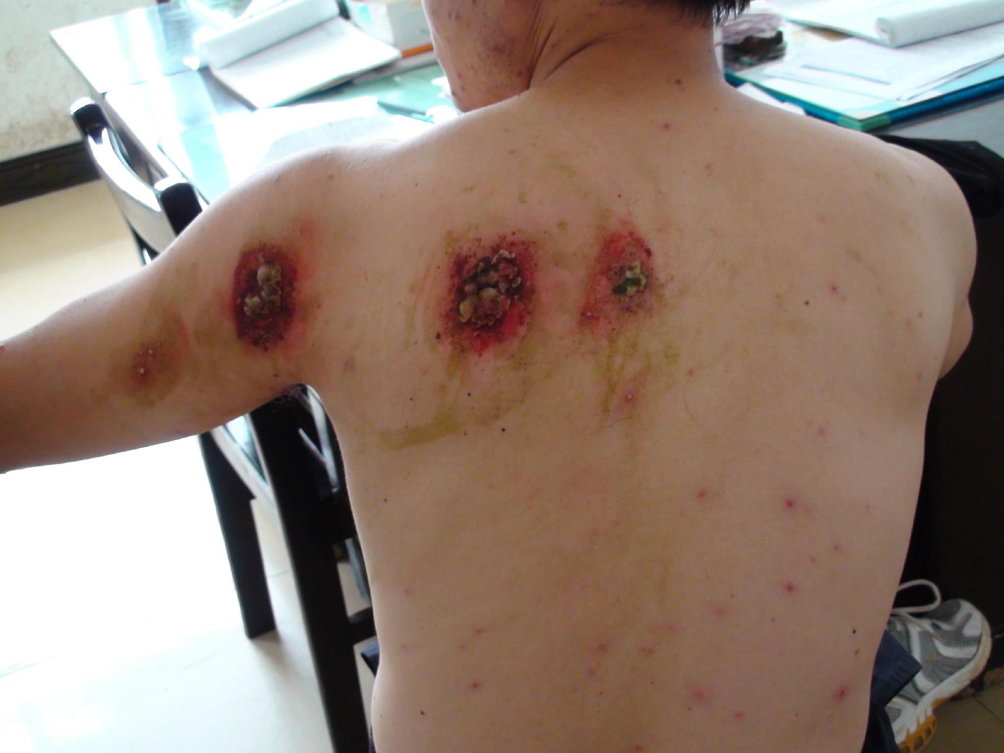 背部带状疱疹症状的图片