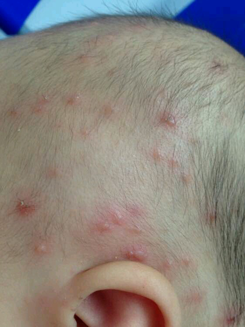 儿童水痘初期症状图片