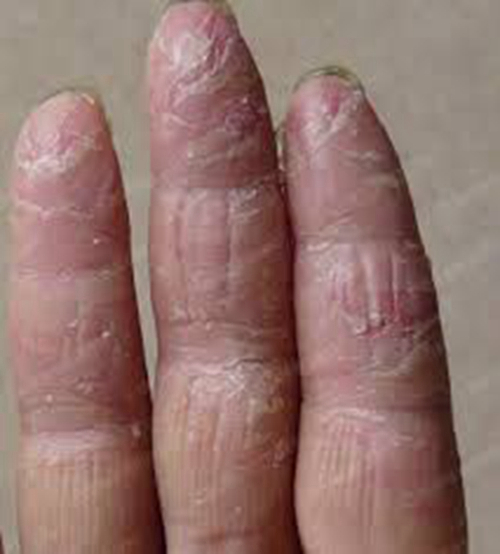 指尖的手部湿疹图片