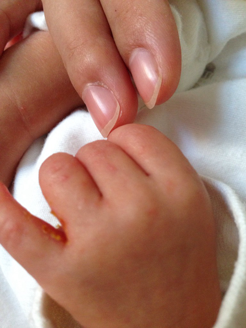 婴儿手部湿疹图片