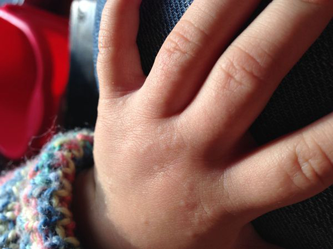宝宝手湿疹症状图片