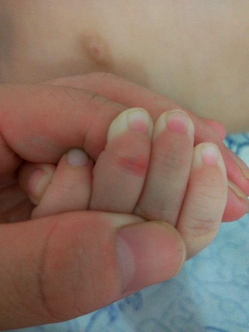 小婴儿手部湿疹图片