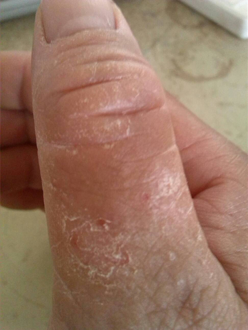 手角化型湿疹图片
