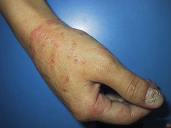 感染手部湿疹的图片
