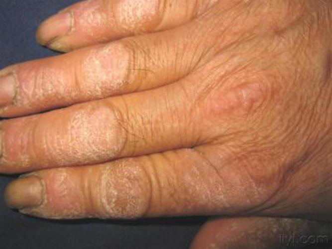 手部湿疹干燥的图片