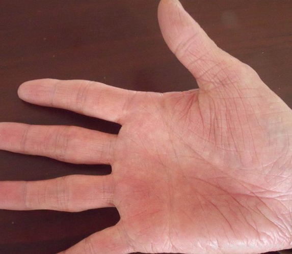 手部湿疹症状的图片